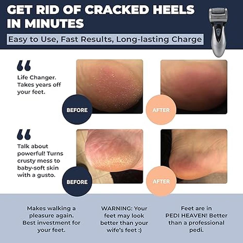Electric Callus Remover: Own Harmony CR900 Rechargeable – Side View