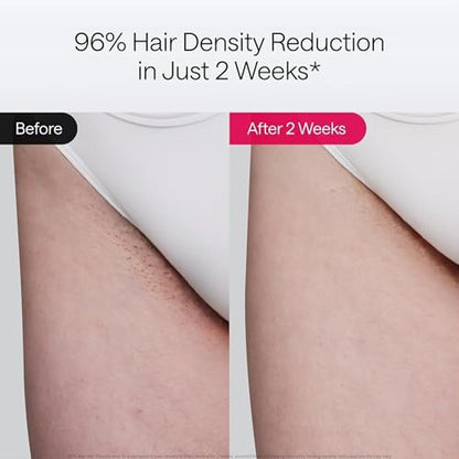Ulike Laser Hair Removal Air 10 Deluxe Version IPL for for – Side View