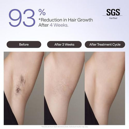 Ulike Laser Hair Removal Device Air 4 Ipl Gift for Women – Side View